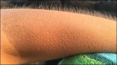 Lorsqu'on a froid on a la chair de poule. Quels muscles permettent cette réaction ?