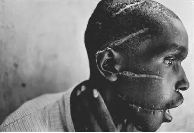 Pourquoi cet Hutu s'est-il fait mutilé le visage par la milice Hutus lors du génocide des Tutsis au Rwanda ?