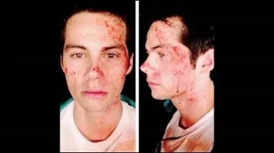 À quel moment s'est-il blessé lors d'un tournage ?