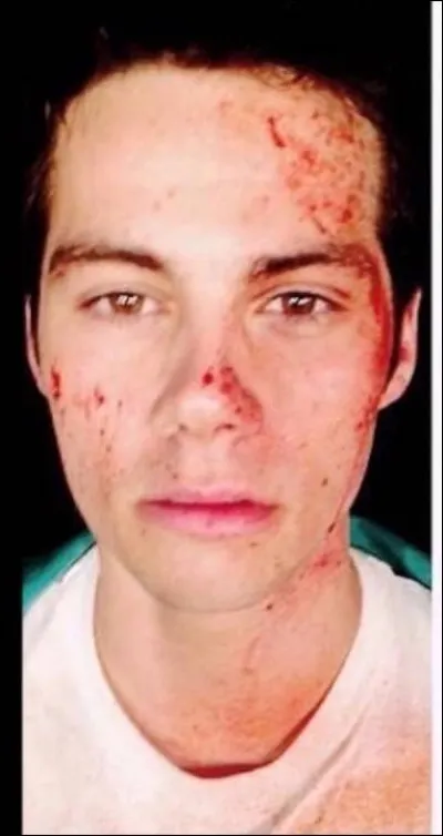 Dans quel film ou s&eacute;rie a-t-il eu un accident ?