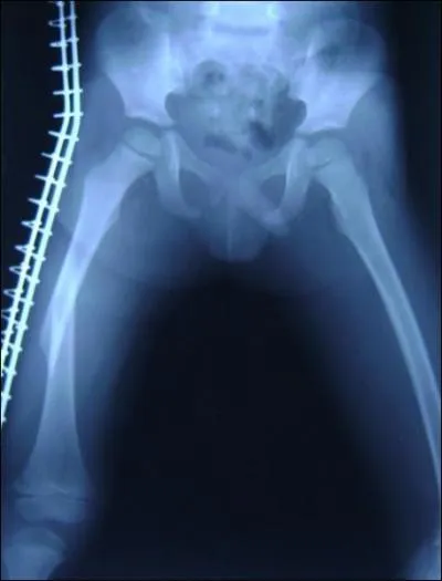 Le fmur est l'os le plus long du corps humain.