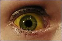 La jaunisse est une maladie.