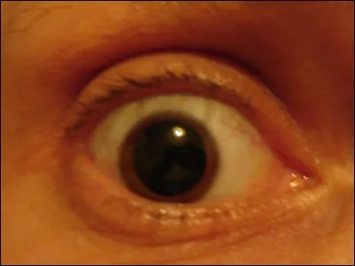 La dilatation prolongée et excessive de la pupille est la ...