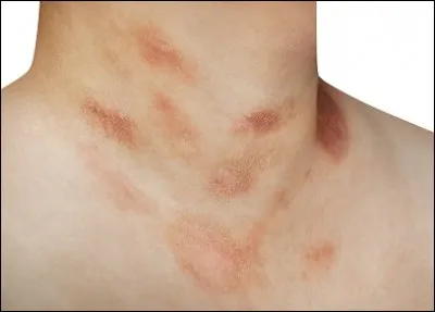 Une dermatose dont les lésions sont couvertes de fines squames est un ...