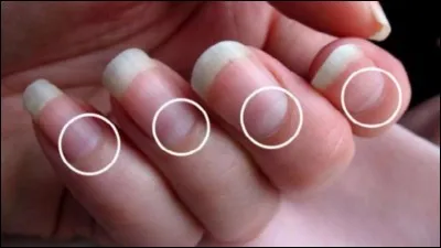 Comment s'appelle la partie blanche que nous avons sur nos ongles ?