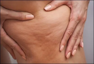 Qu'appelle-t-on plus spécifiquement la peau d'orange ?