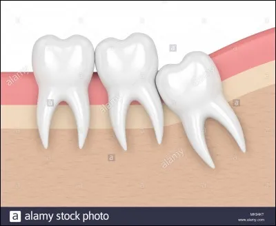 Quel est le nombre maximum de dents de sagesse que possède l'adulte moyen ?