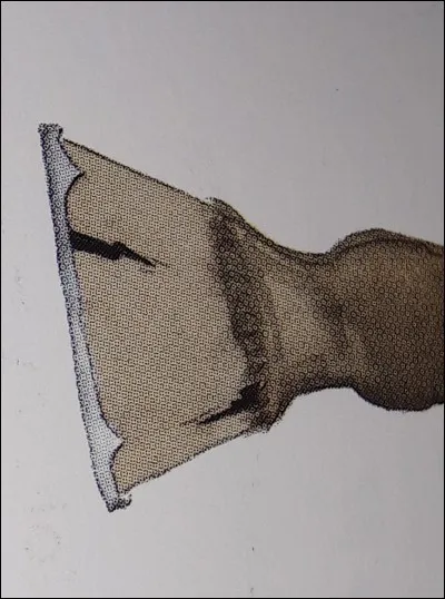 Quelle est cette blessure ?