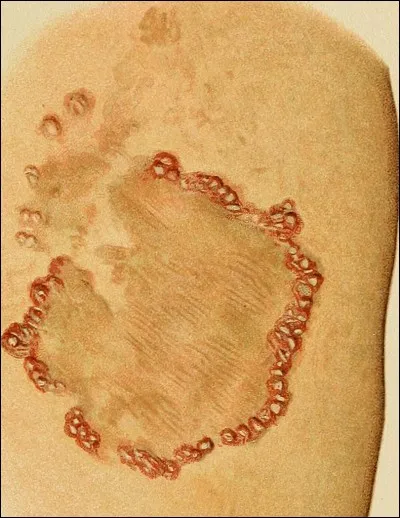 D'Italie on ne ramène pas que de jolies choses. Depuis Charles VIII, bon nombre de soldats reviennent avec le mal de Naples. Quel est donc ce mal qui se répand en Europe ?