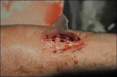 Plaie qui saigne avec un corps étranger ?