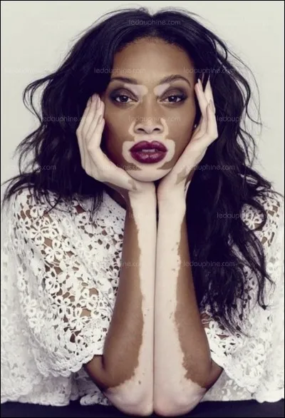 Santé : Quelle maladie chronique de l'épiderme se caractérise par des taches blanches (dépigmentation) sur la peau ?