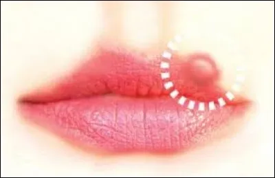 À quel virus est dû le bouton de fièvre ?