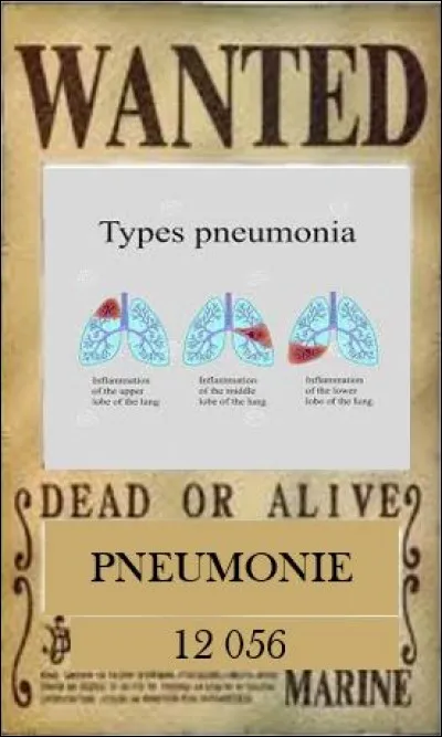 La première cause infectieuse de décès en France est la pneumopathie infectieuse ou pneumonie. 
Quelle association de symptômes est évocateur de pneumonie ?