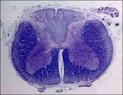 Maladie de la moelle épinière d'origine syphilitique qui se manifeste par des troubles de la motricité et de violentes douleurs :