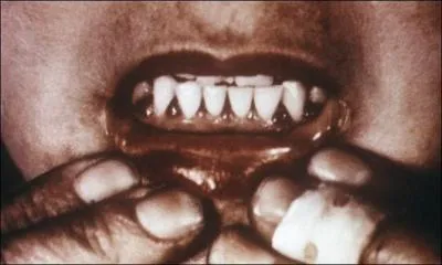 Le scorbut rsulte d'un manque de vitamine ...