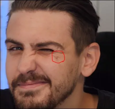 Pourquoi a-t-il une cicatrice sur le côté de la joue ?