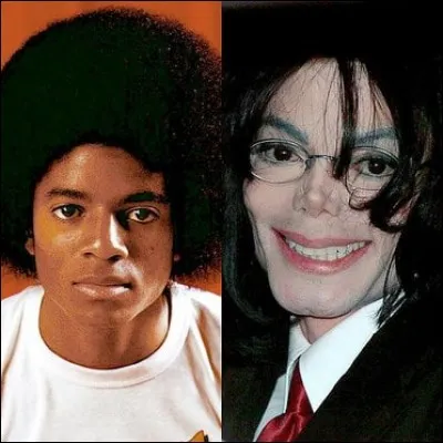 De quelle maladie de peau souffrait Michael ?