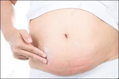 La péritonite est l'aggravation d'une appendicite non traitée.