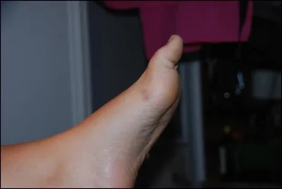 Notre second patient nous dit avec un peu de mal qu'il a du mal à ouvrir la mâchoire, de parler et que les muscles de son visage se crispent. Certains muscles de son corps se contractent sans raison. Une semaine avant, il s'était transpercé le pied avec une vis rouillée. Ce patient va contracter :