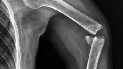 De quelle manière Bane a-t-il blessé Batman ?