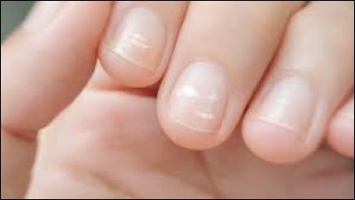 Les taches blanches sur les ongles sont le signe d'un manque de calcium