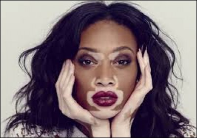 Le vitiligo est une maladie de peau caractérisée par l'apparition de taches blanches.