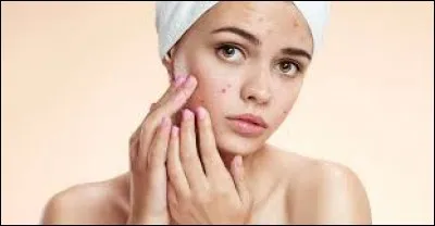 L'acné marque l'adolescence d'environ 60 % des gens.