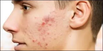 L'acné survient généralement à l'adolescence et est liée à l'hypersécrétion de sébum.