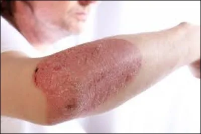Les poussées de psoriasis peuvent également être liées à une consommation excessive de tabac et de boissons alcoolisées.