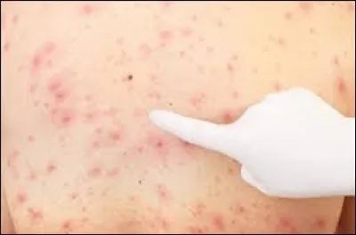 L'acné ne semble pas affecter les populations non occidentalisées de la Papouasie-Nouvelle-Guinée et du Paraguay.