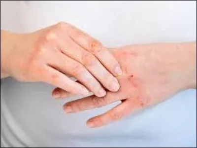 L'eczéma est une maladie de la peau contagieuse.