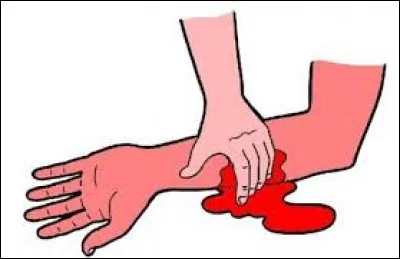 Sur une h&eacute;morragie, la r&egrave;gle des AAA (3A) signifie :