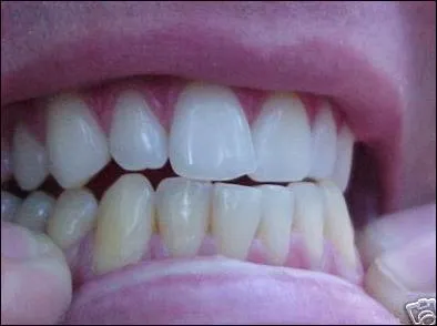 Grincer des dents pendant la nuit, est-ce le signe d'un trouble du sommeil ?