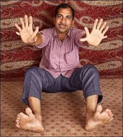 Comptez bien combien de doigts et d'orteils a l'Indien Devendra Suthar.