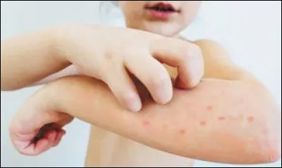 Le coronavirus a un taux de mortalité plus élevé que la rougeole.