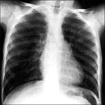 Quels rayons utilise la radiographie ?