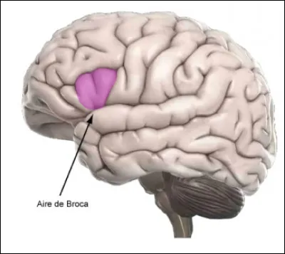 Qu'est-ce qu'une aphasie de Broca ?