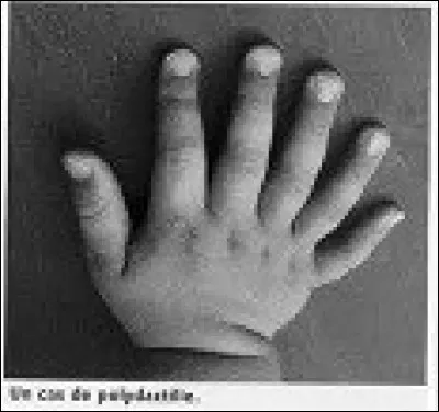 Je suis polydactyle, je possède un sixième (...) à chaque main.