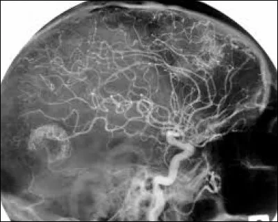 En oncologie, comment se caractérise le stade terminal d'un cancer (stade 4) ?