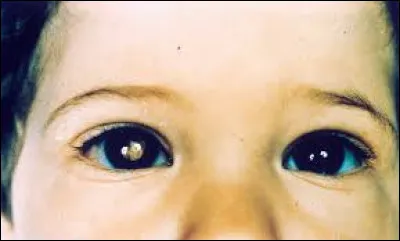 Pour être atteint de rétinoblastome, il faut être porteur...