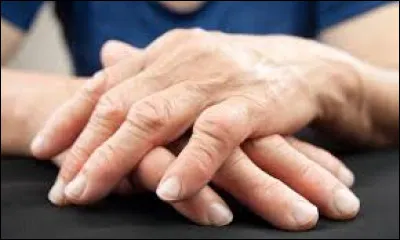 SVT : Combien d'années de vie perdent les personnes atteintes de polyarthrite rhumatoïde en moyenne par rapport à la population générale ?