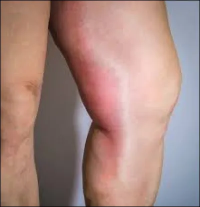 SVT : Pourquoi une phlébite est dangereuse ?