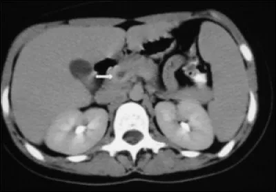 L'anatomie en image : êtes-vous capable d'identifier quelle structure anatomique n'est pas présente sur ce CT-scan ?