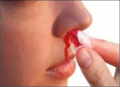 Comment appelle-t-on les saignements de nez ?