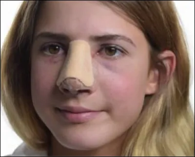 La fracture du nez est considérée comme étant la plus fréquente des fractures faciales. Chez les sportifs pratiquant quelle discipline survient-elle souvent ?