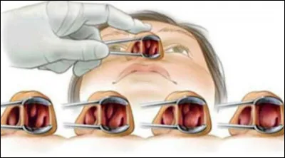La polypose naso-sinusienne est une maladie inflammatoire et chronique se traduisant par l'épaississement de la muqueuse nasale. Grâce à quel moyen d'exploration peut-on facilement en faire le diagnostic ?