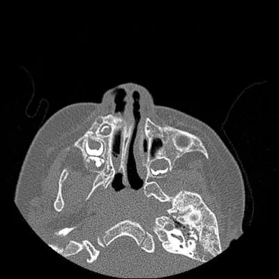 Quel est le nom de cette maladie congénitale rare qui correspond à la fermeture d'une ou des deux choanes, des orifices reliant les fosses nasales au rhinopharynx ?