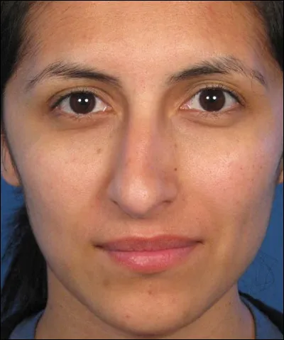 Comment appelle-t-on ce type de nez un peu décalé ?