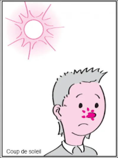 Ce nez-là a tellement pris le soleil, qu'il est calciné !