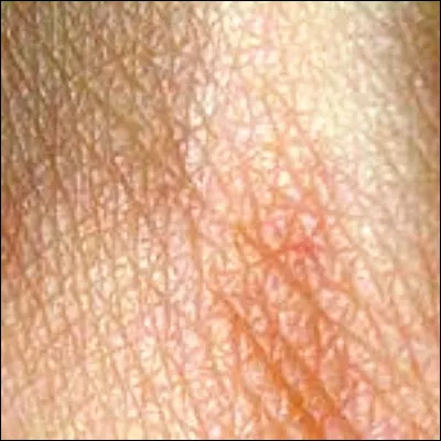 Sous quel nom est plus couramment connu l'&eacute;ryth&egrave;me actinique ?